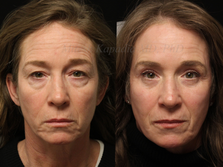 before after bleph