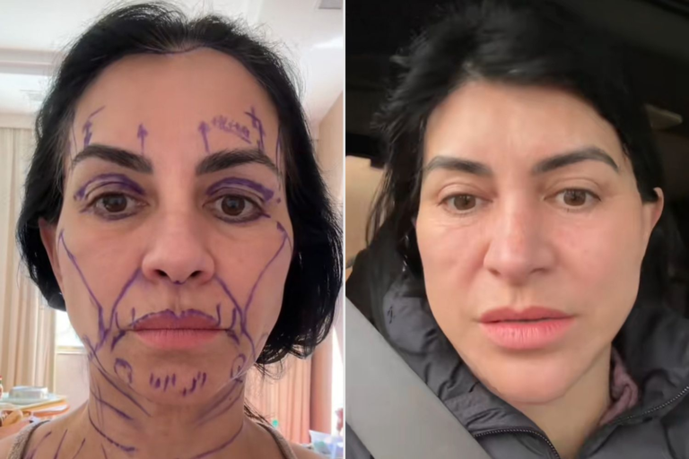 botched mini face lift